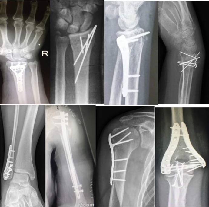 Different Xray Pictures